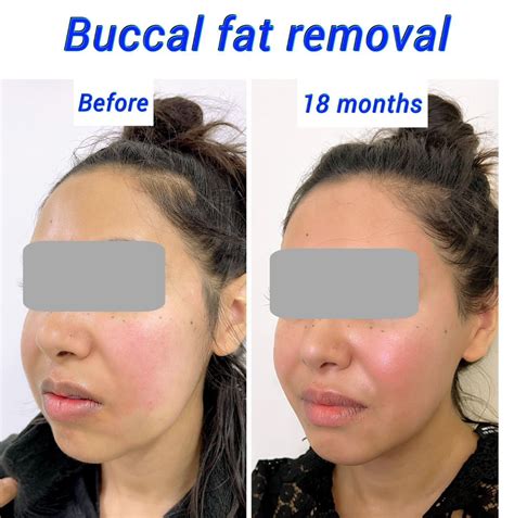 buccal fat removal norge|Fat pad reduction cheek .